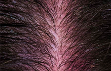 Sensitive Scalp